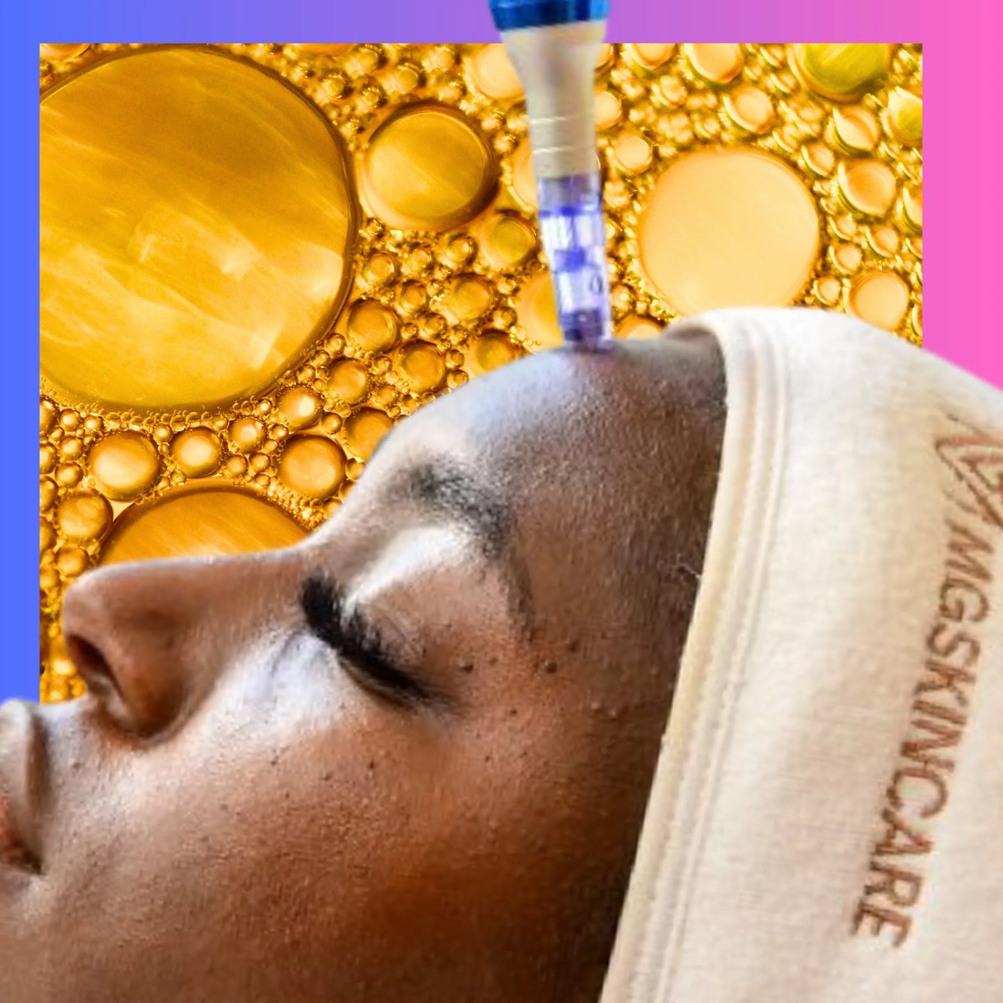 FACIAL SKIN NEEDLING ( with combination of PEELS )