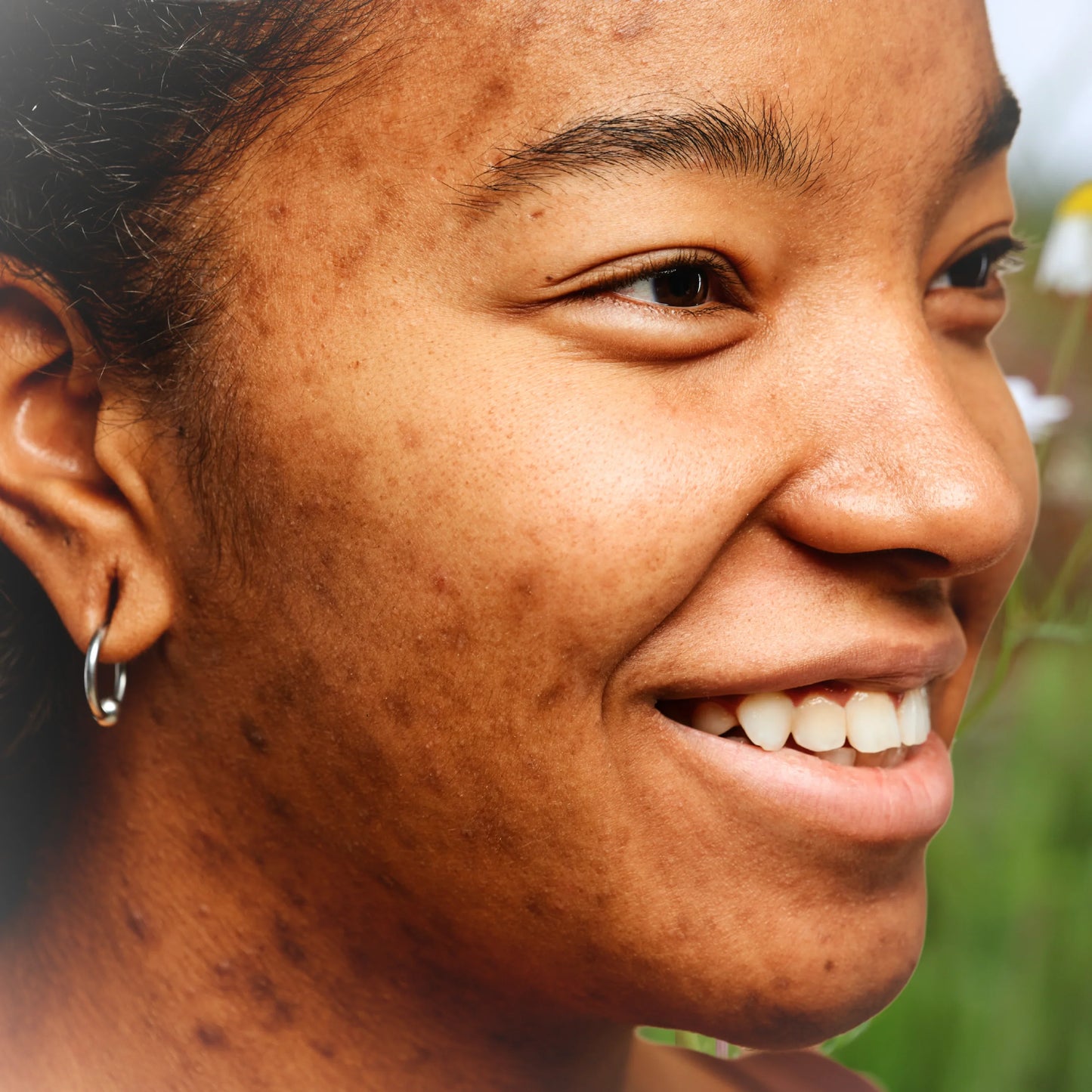 Facial Acne + Congestion