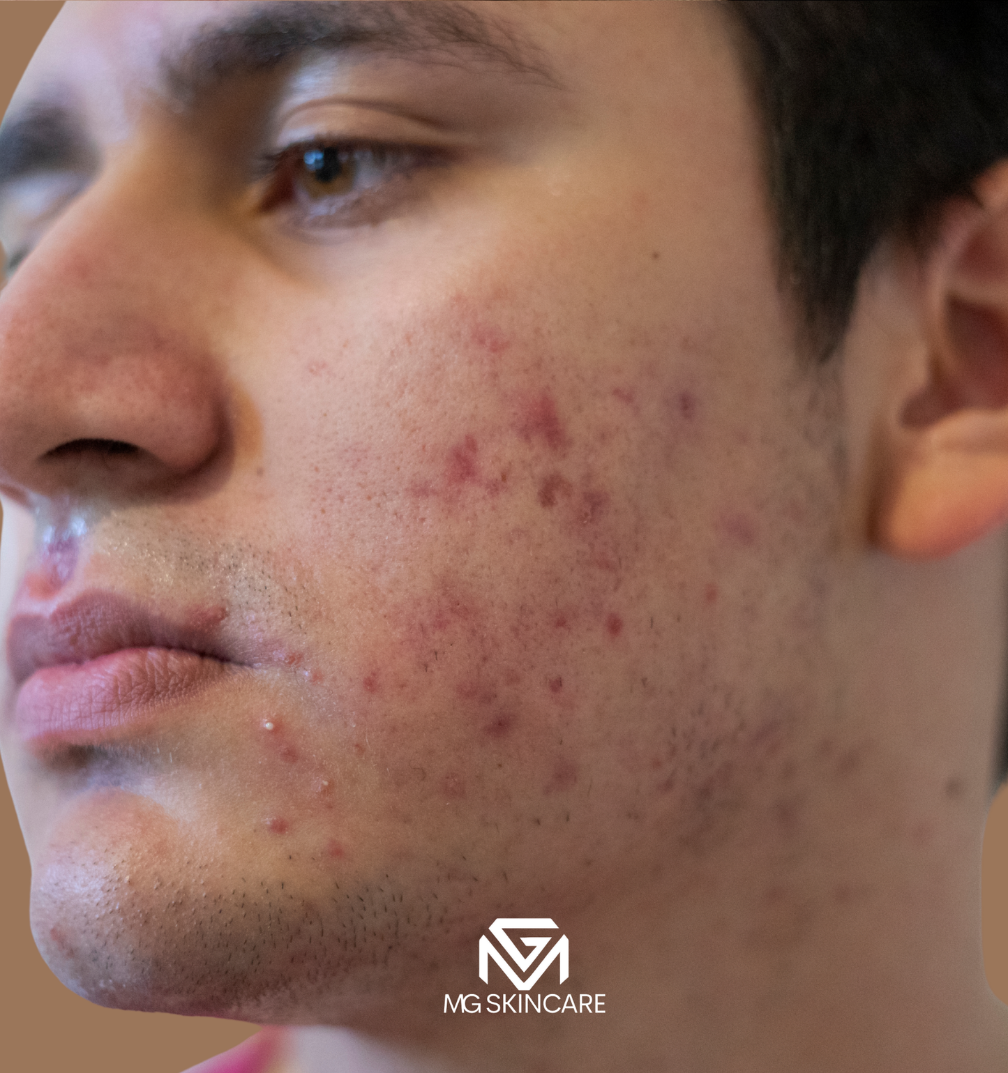 NORMAL BASIC TRADITIONAL ACNE/CONGESTION FACIAL IN SE1. 45min