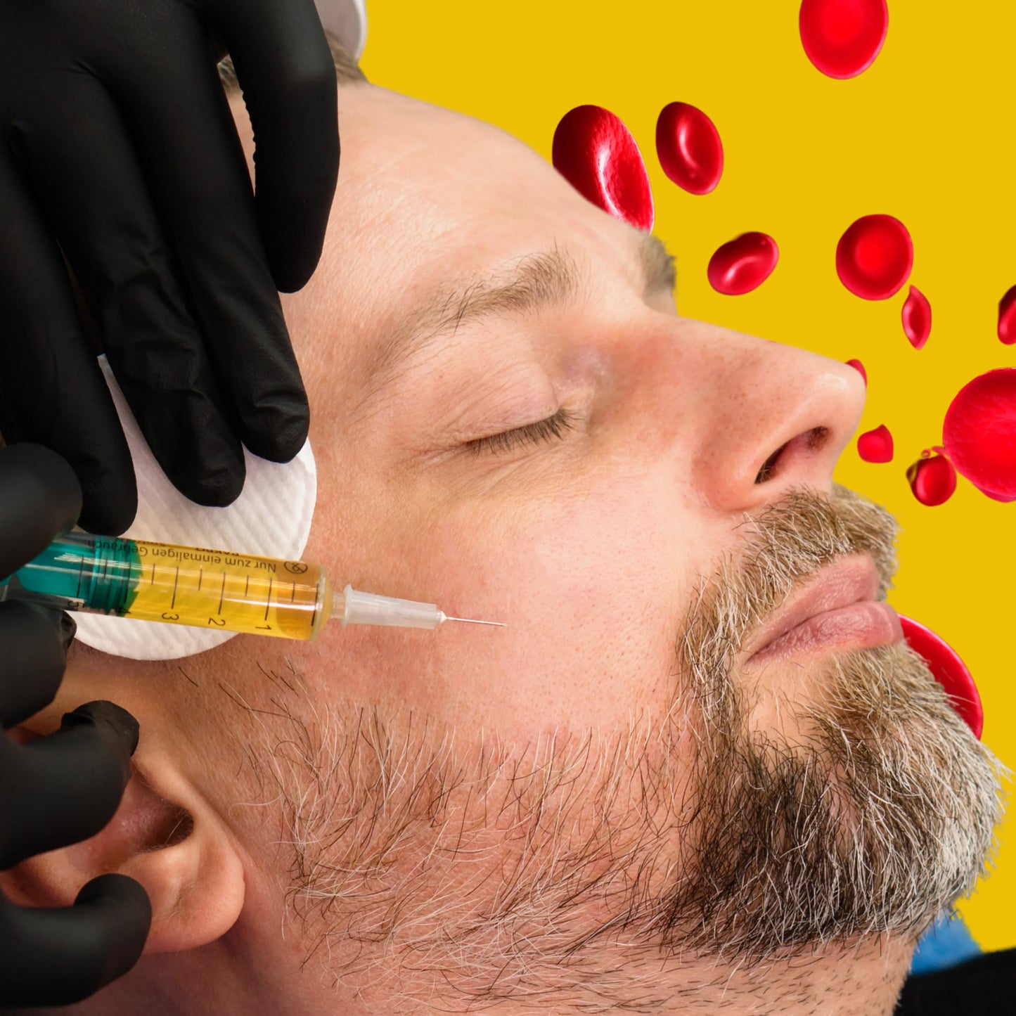 PRP Facelift + Fillers