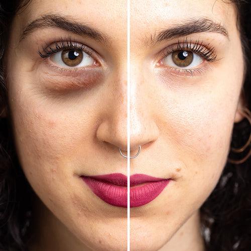 REMOVE DARK CIRCLES IN A WEEK NATURALLY