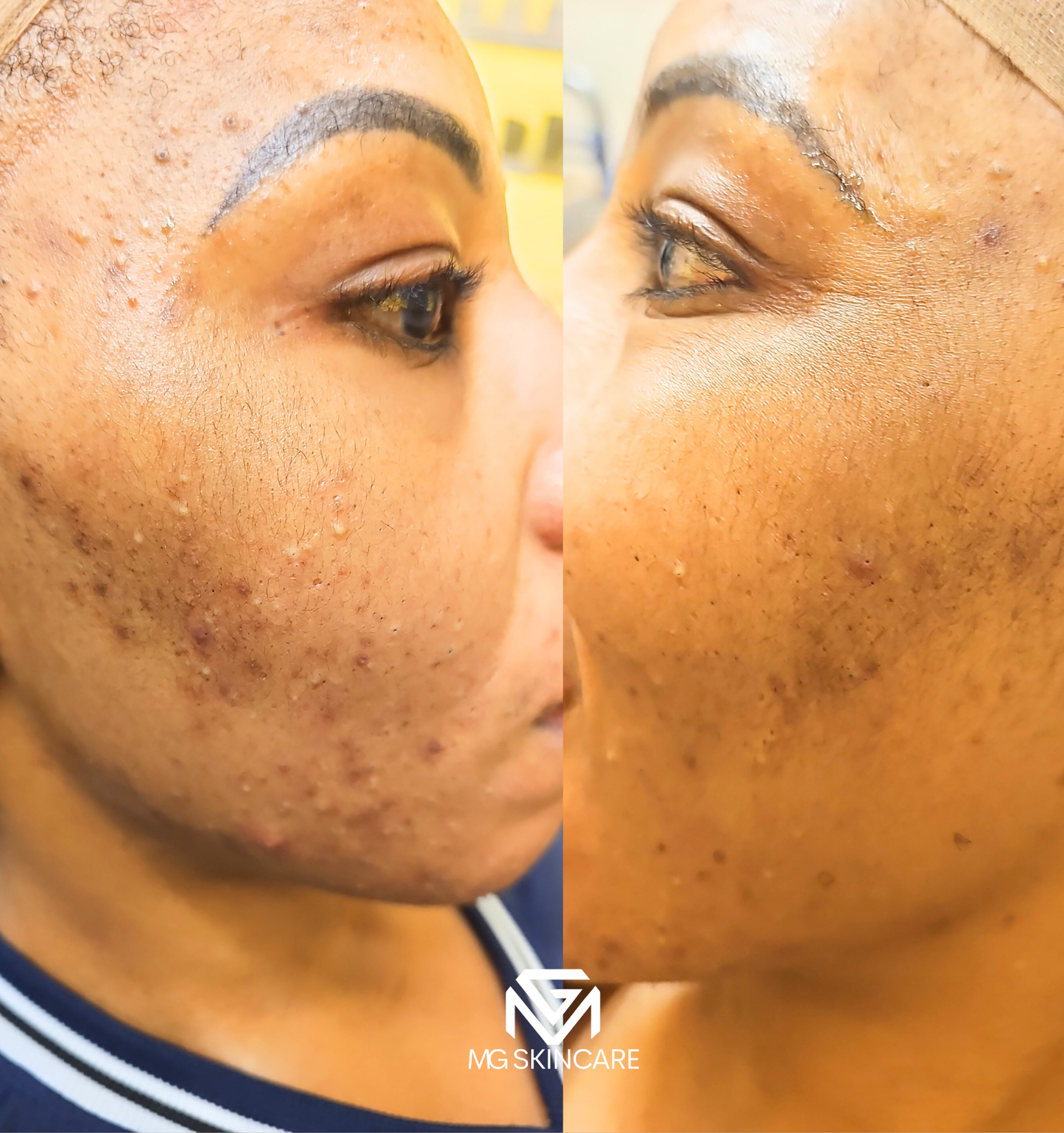 NORMAL BASIC TRADITIONAL ACNE/CONGESTION FACIAL IN SE1. 45min