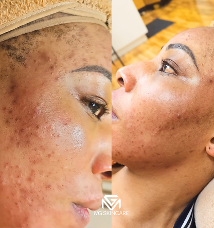 NORMAL BASIC TRADITIONAL ACNE/CONGESTION FACIAL IN SE1. 45min