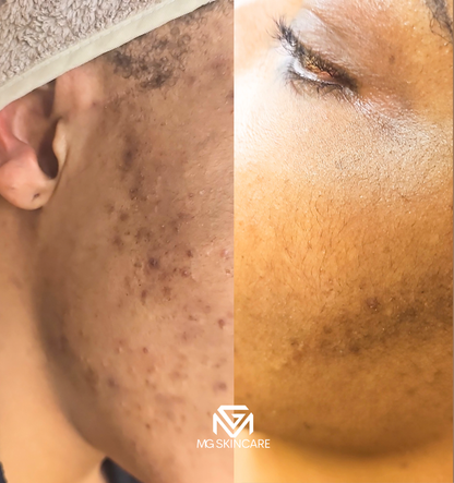 NORMAL BASIC TRADITIONAL ACNE/CONGESTION FACIAL IN SE1. 45min