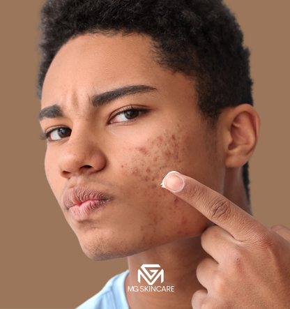 NORMAL BASIC TRADITIONAL ACNE/CONGESTION FACIAL IN SE1. 45min