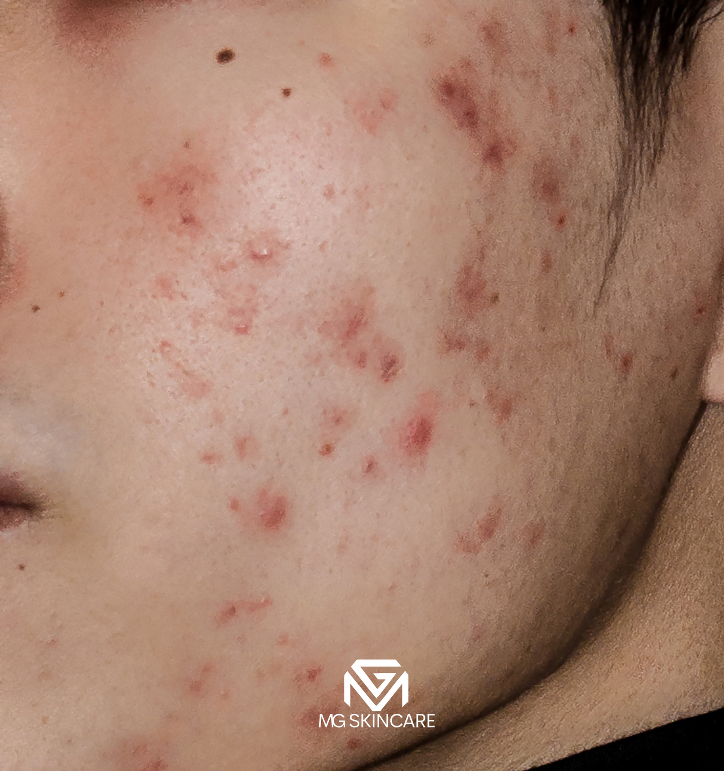 NORMAL BASIC TRADITIONAL ACNE/CONGESTION FACIAL IN SE1. 45min