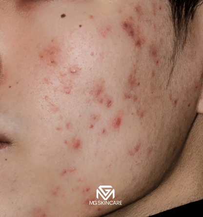 NORMAL BASIC TRADITIONAL ACNE/CONGESTION FACIAL IN SE1. 45min