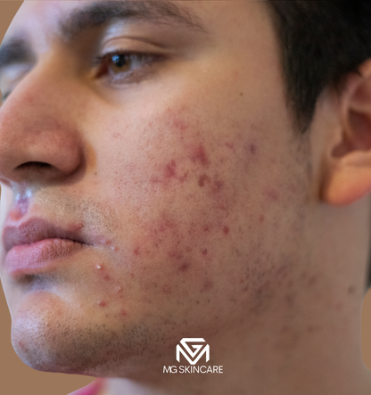 NORMAL BASIC TRADITIONAL ACNE/CONGESTION FACIAL IN SE1. 45min