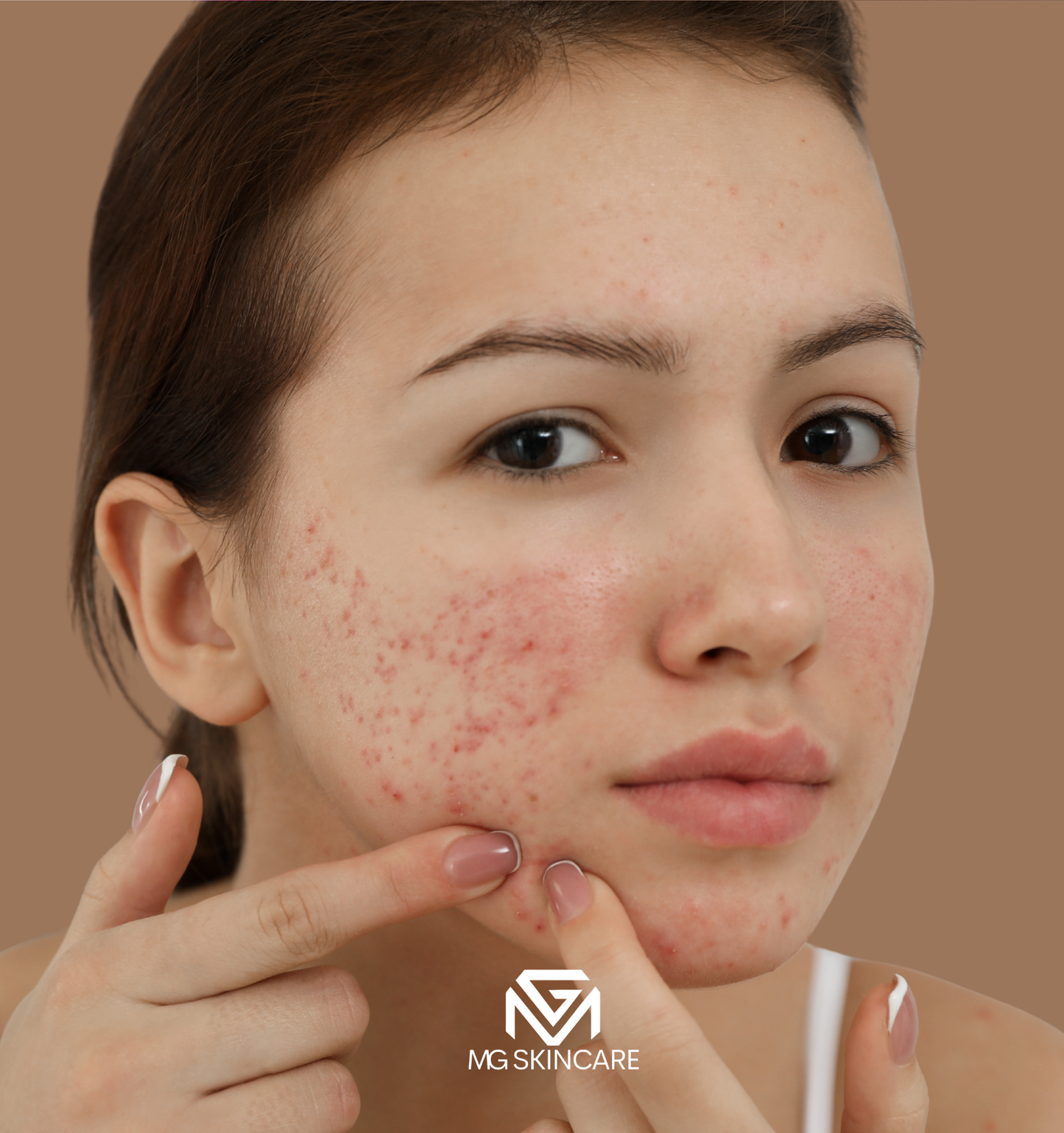 NORMAL BASIC TRADITIONAL ACNE/CONGESTION FACIAL IN SE1. 45min