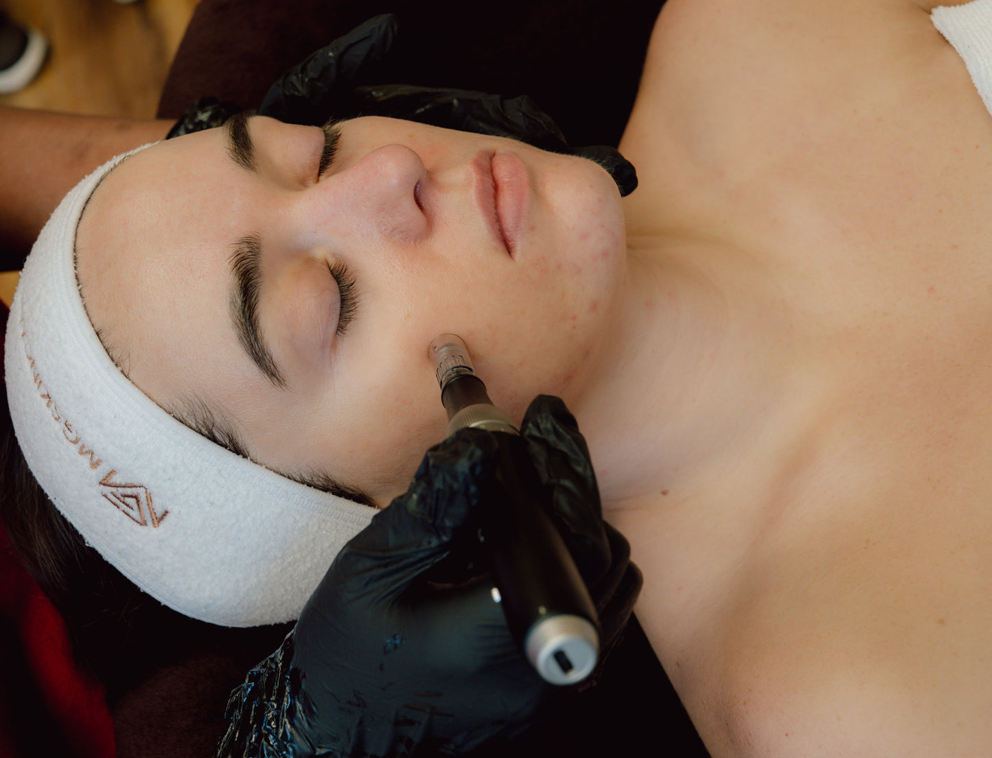 ADVANCED SKIN NEEDLING WITH PEELS. TREATING PIGMENTATION, ACNE, ACNE SCARS & AGEING SKIN.