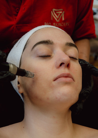 ADVANCED SKIN NEEDLING WITH PEELS. TREATING PIGMENTATION, ACNE, ACNE SCARS & AGEING SKIN.