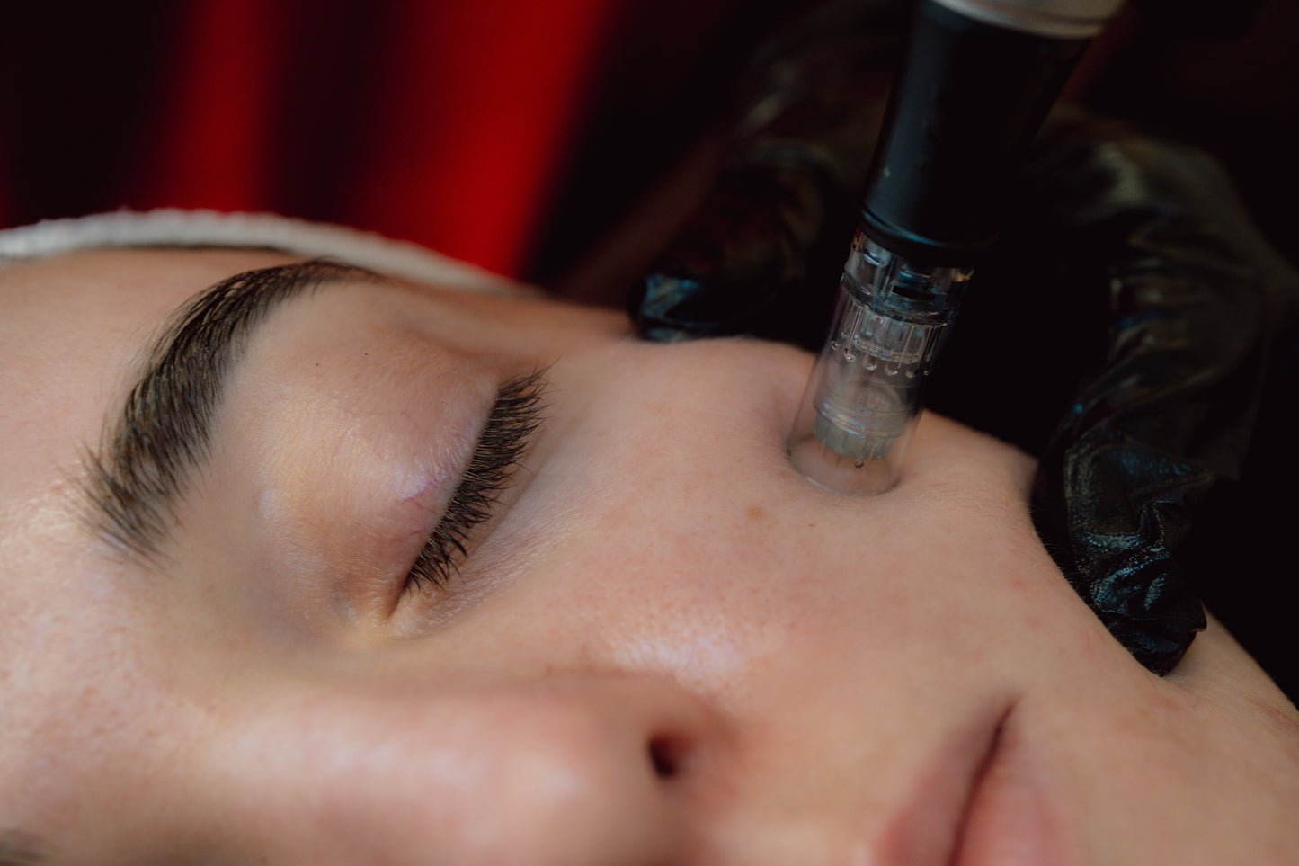 ADVANCED SKIN NEEDLING WITH PEELS. TREATING PIGMENTATION, ACNE, ACNE SCARS & AGEING SKIN.