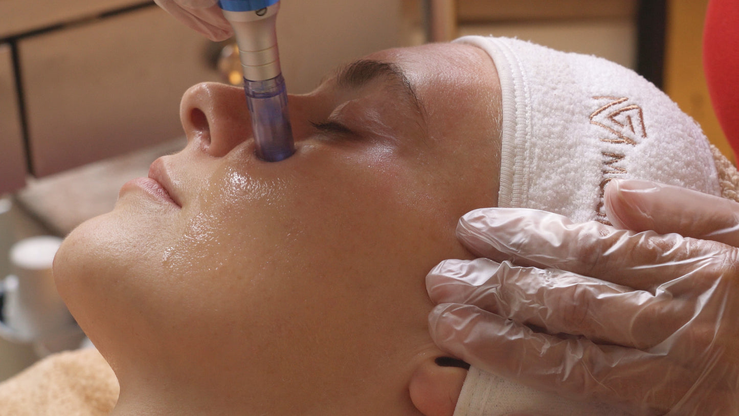 FACIAL SKIN NEEDLING ( with combination of PEELS )